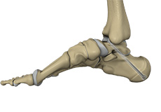 Subtalar Arthrodesis