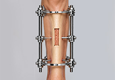 Tibial Transport Osteotomy for Diabetic Foot Ulcers