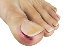 Toenail Conditions