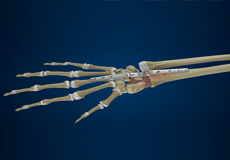 Total Wrist Arthrodesis