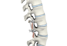 Transforaminal Lumbar Interbody Fusion (TLIF)