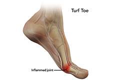 Turf Toe