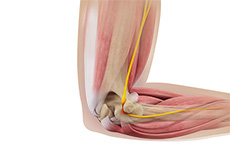 Ulnar Nerve Neuropathy