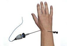 Wrist Arthroscopy